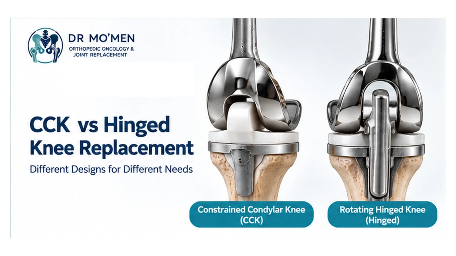 Educational medical illustration comparing a constrained condylar knee with a rotating hinged knee for complex knee reconstruction.