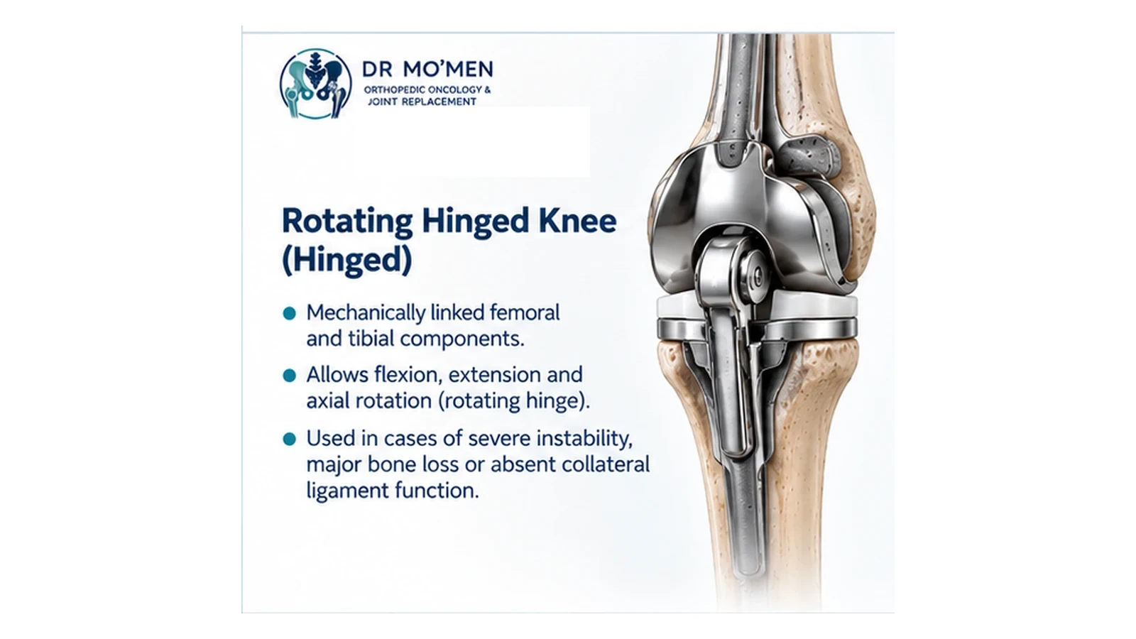 Medical illustration of a rotating hinged knee used for severe instability or major ligament deficiency.