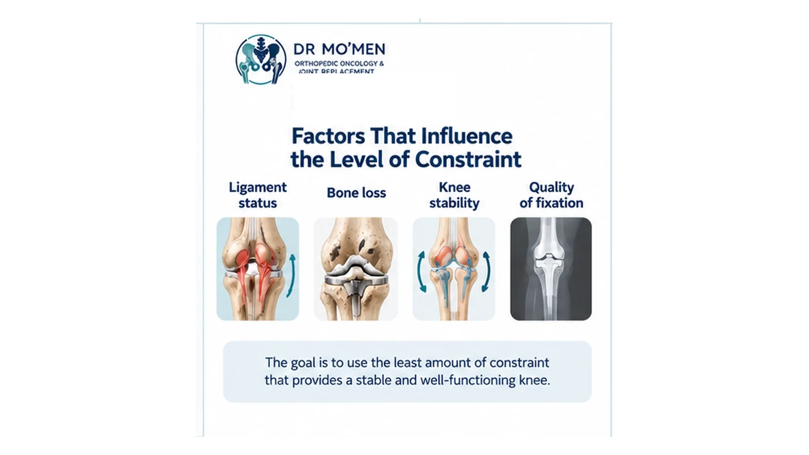 Infographic showing ligament status, knee stability, bone loss and fixation quality as factors in choosing implant constraint.