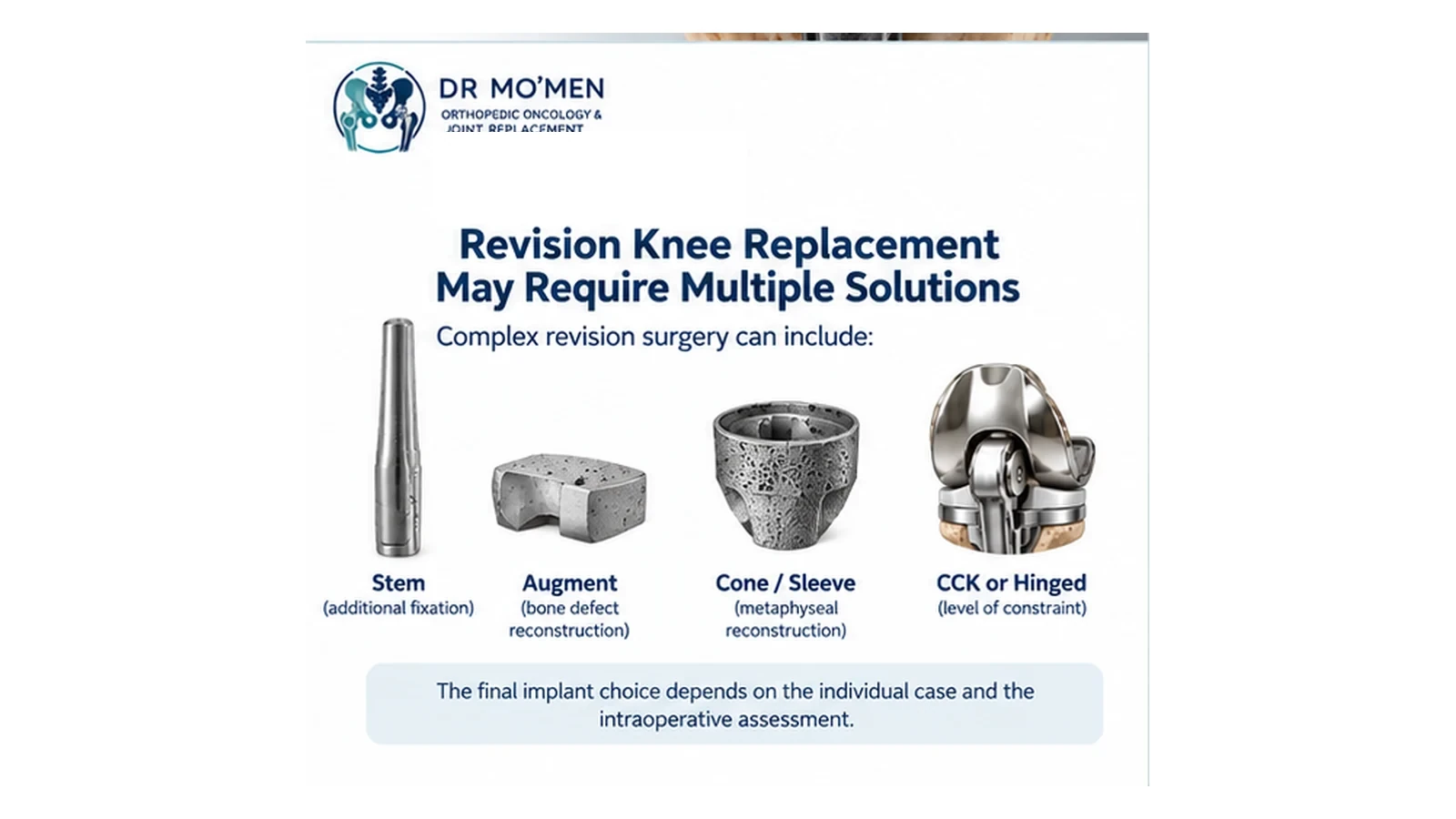 Medical infographic showing stems, augments, metaphyseal cones or sleeves and implant constraint in complex revision knee reconstruction.
