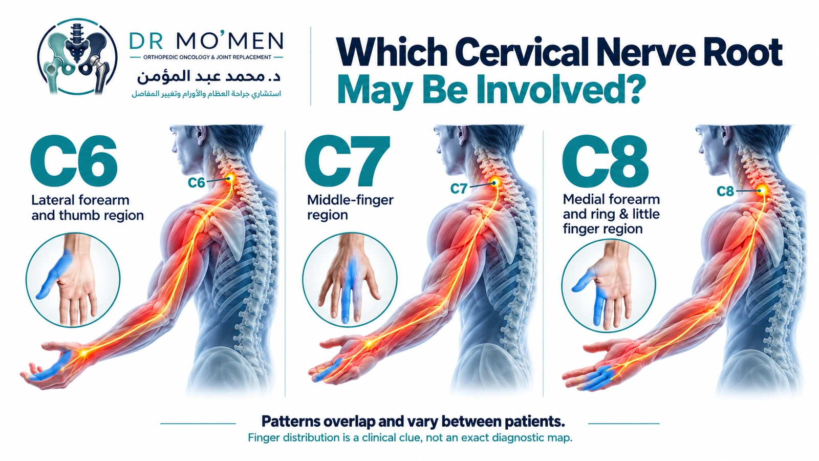Approximate C6, C7 and C8 sensory-pattern infographic showing overlapping cervical nerve-root distributions into the arm and hand.