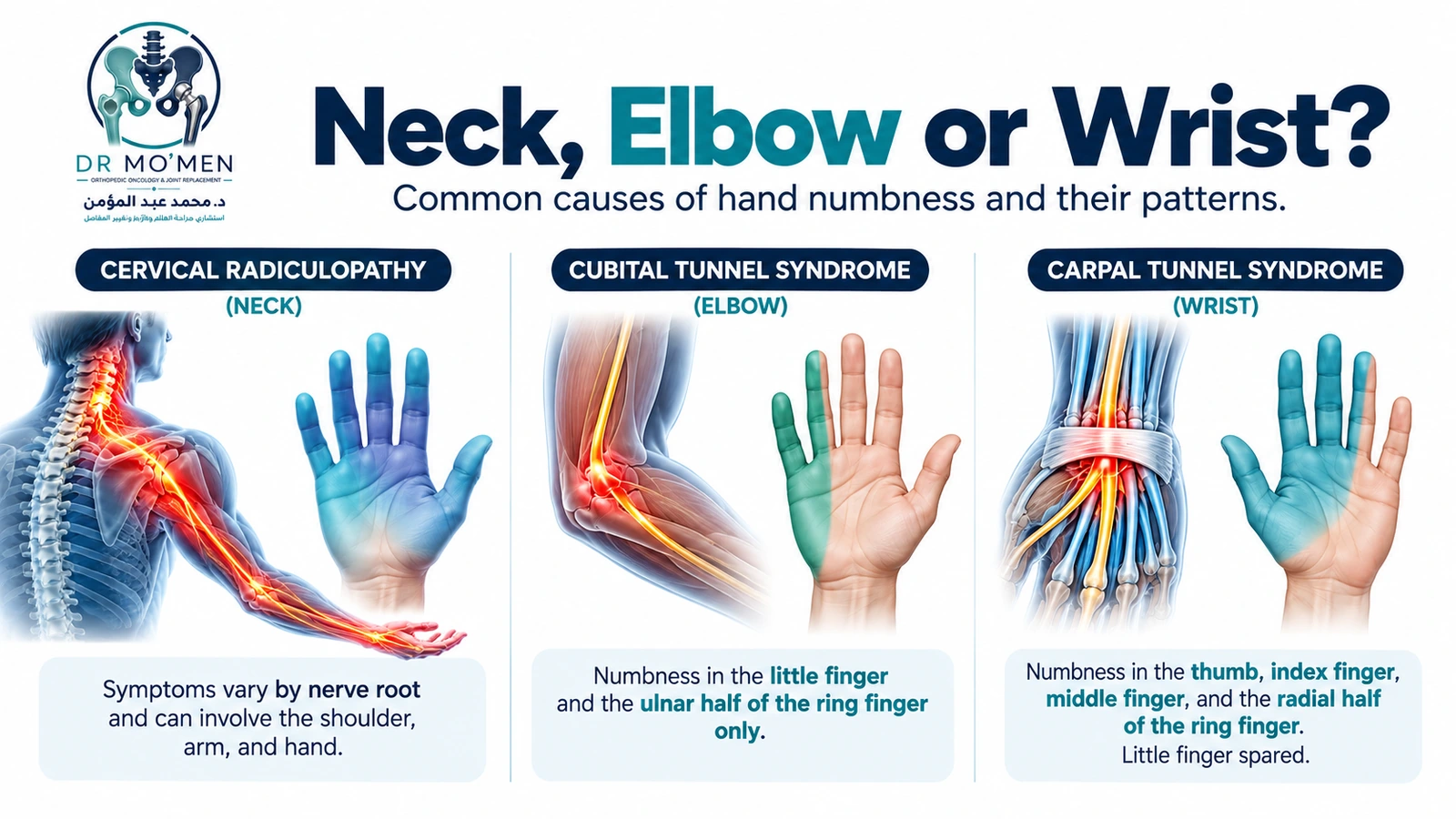 Infographic comparing cervical radiculopathy, cubital tunnel syndrome and carpal tunnel syndrome as causes of hand numbness.
