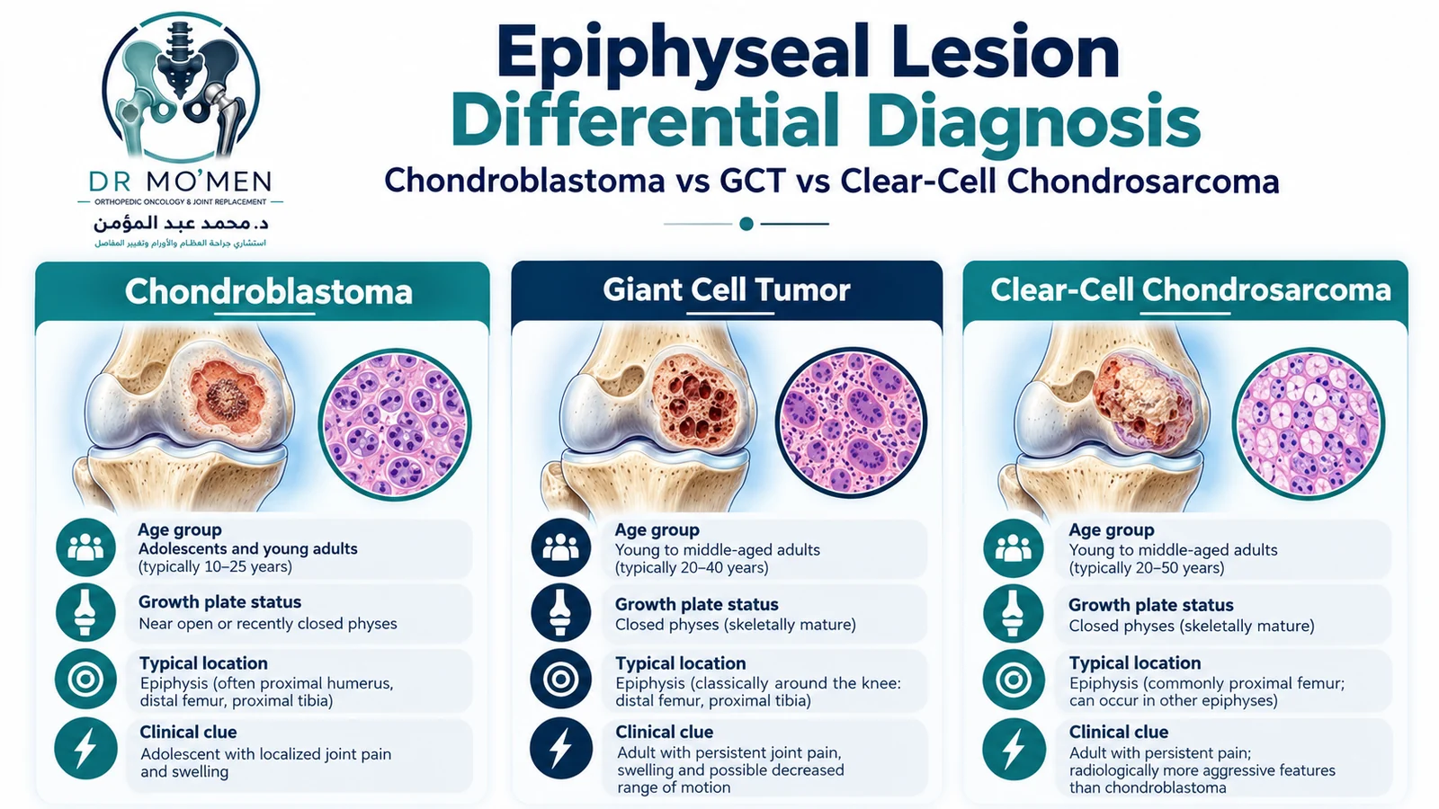 Medical infographic comparing chondroblastoma, giant cell tumor, and clear-cell chondrosarcoma as epiphyseal bone lesions.