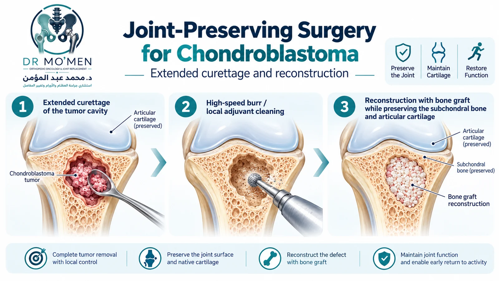 Surgical illustration showing extended curettage, high-speed burr treatment, and bone graft reconstruction for chondroblastoma with joint preservation.