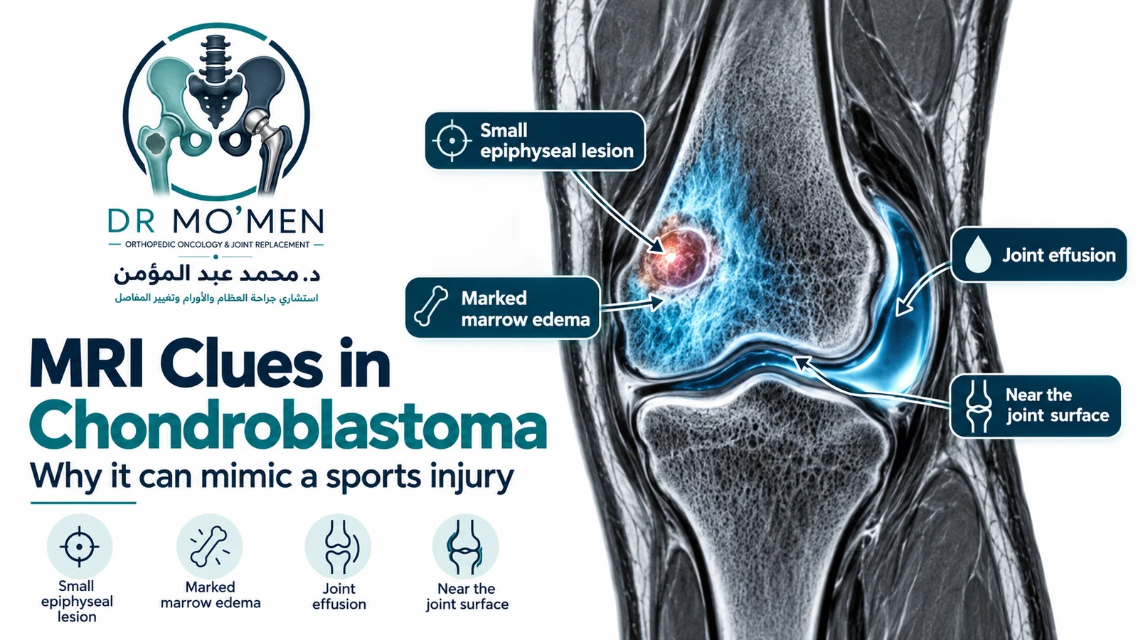 Conceptual MRI-style illustration showing chondroblastoma with extensive surrounding bone marrow edema and joint effusion.