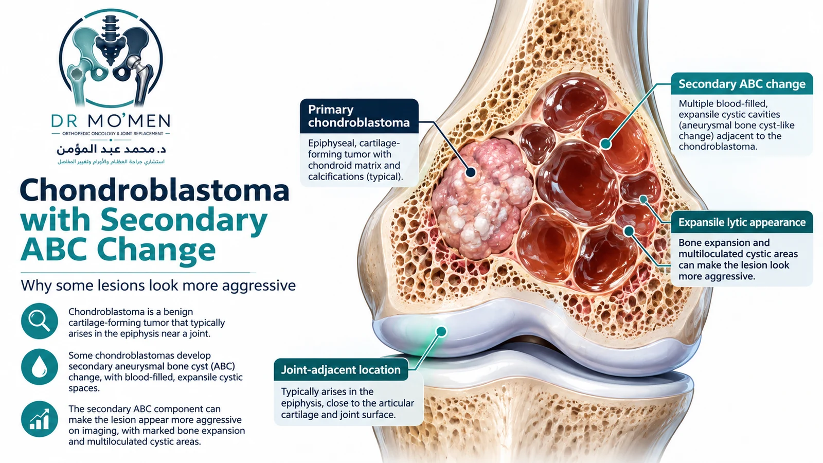 Conceptual radiology-style illustration showing chondroblastoma with secondary aneurysmal bone cyst-like changes.