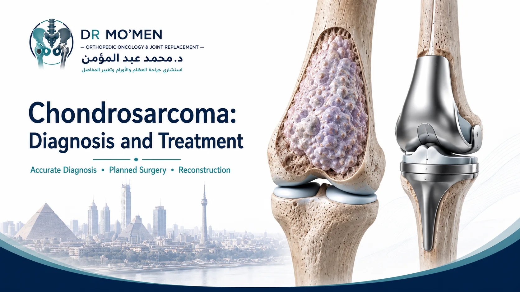3D medical illustration of chondrosarcoma involving the distal femur with orthopedic oncology treatment planning