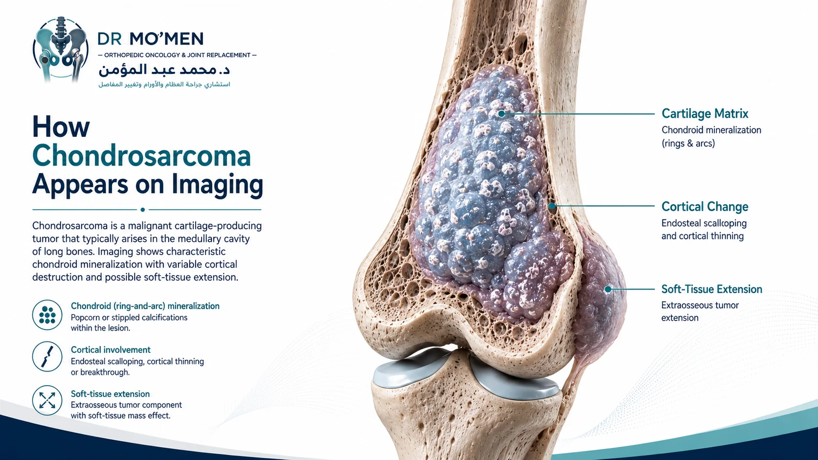 3D orthopedic illustration showing a cartilage-producing bone tumor with chondroid mineralization and cortical involvement
