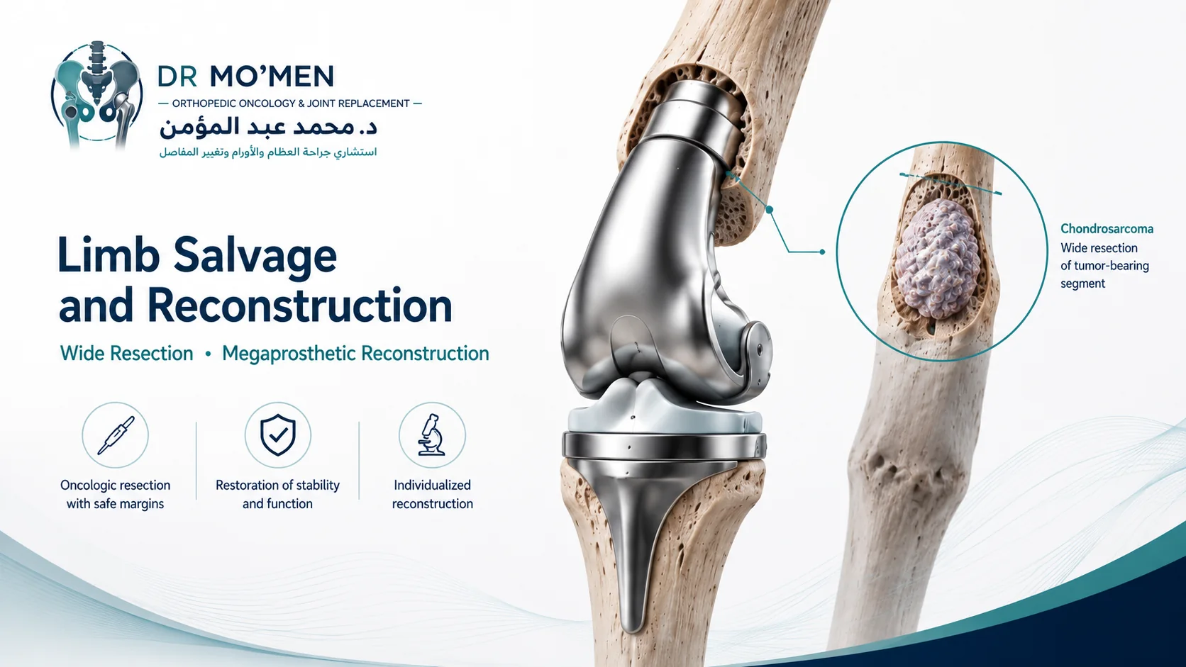 3D distal femoral megaprosthesis reconstruction after wide resection of chondrosarcoma