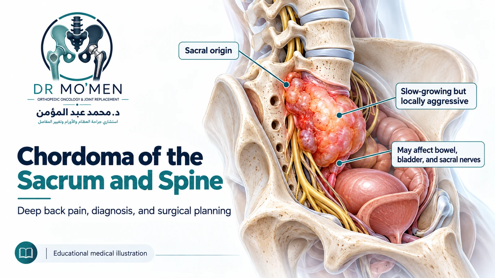 Illustrated anatomy of a sacral chordoma arising near pelvic nerves and organs.
