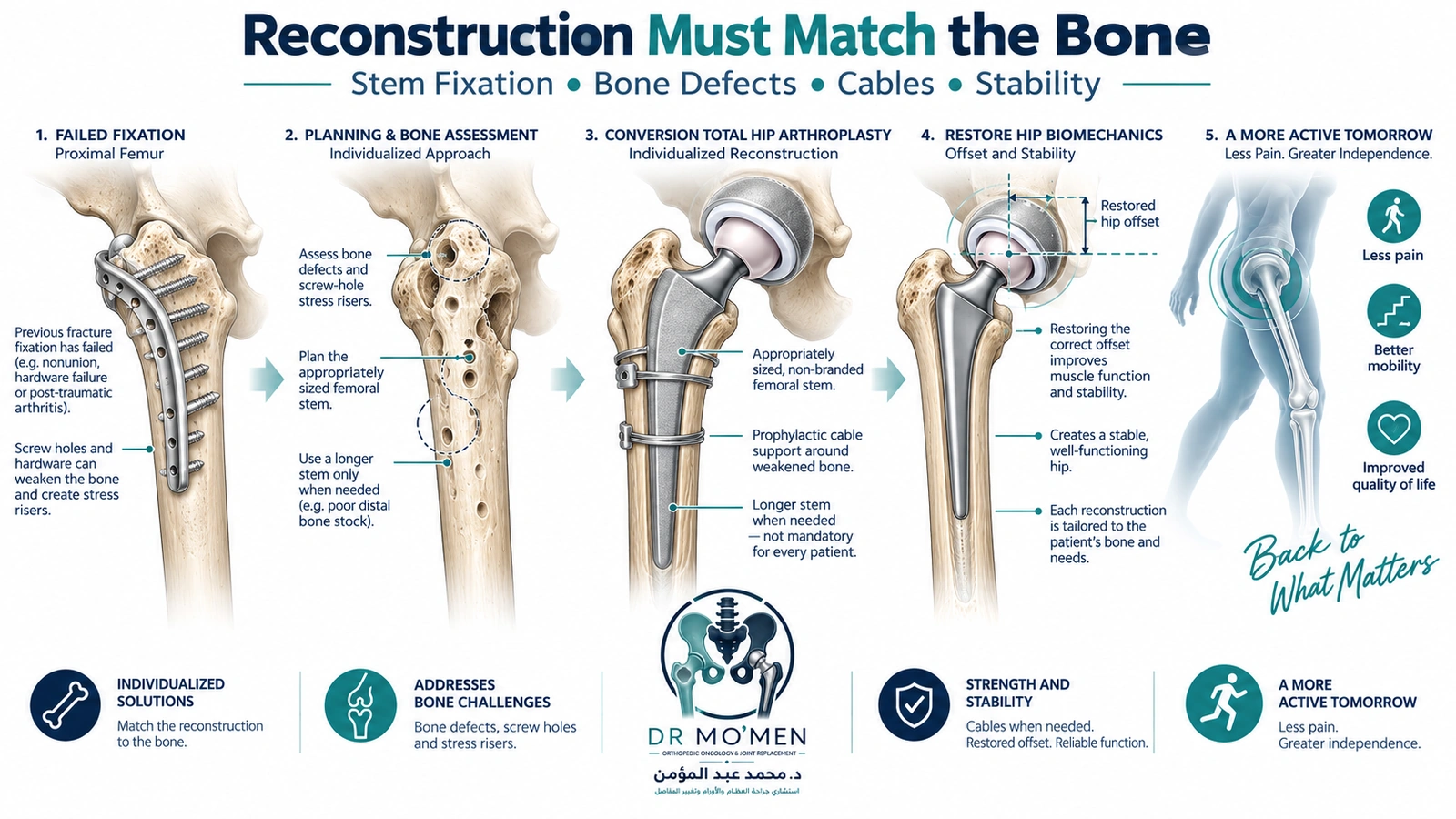 Medical infographic showing individualized femoral reconstruction during conversion total hip replacement after failed fracture fixation.