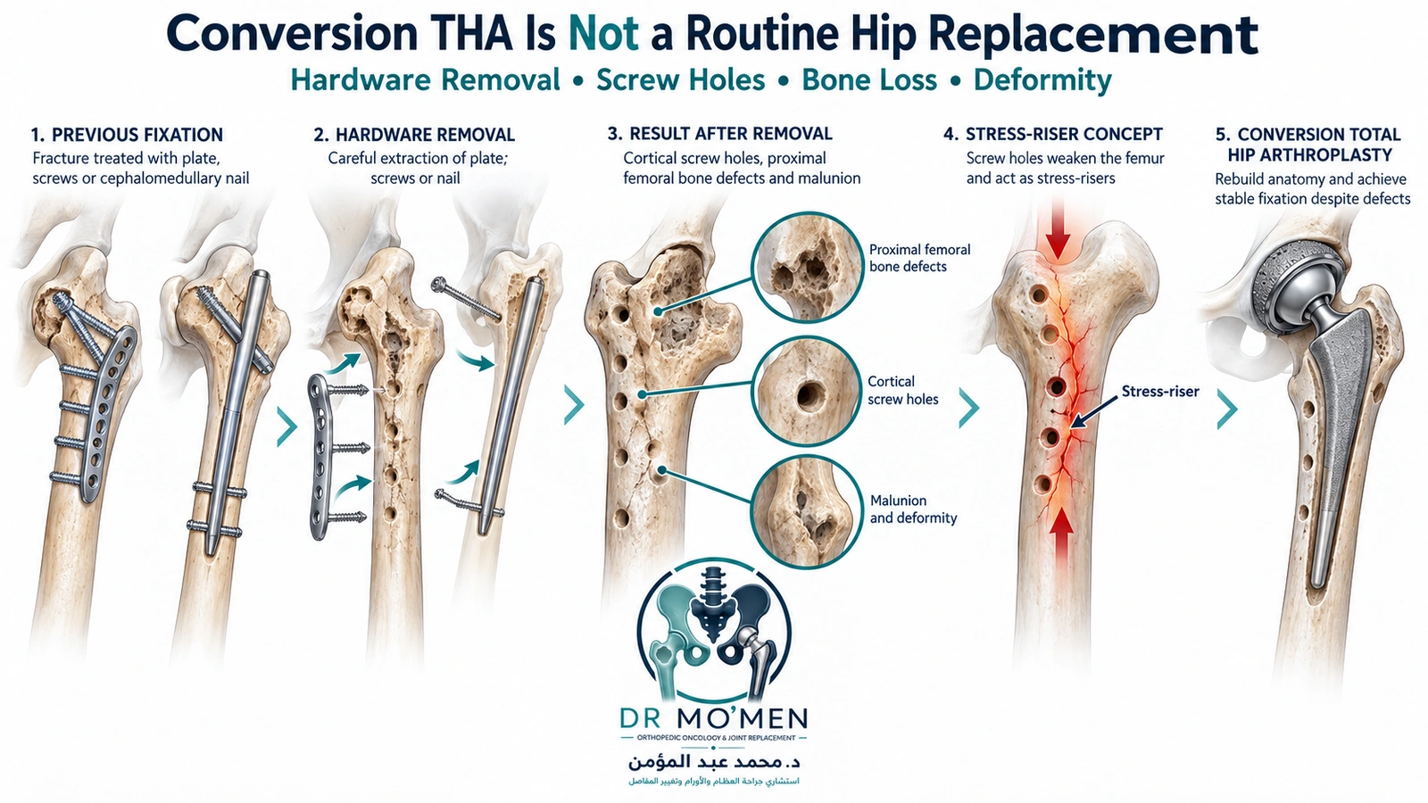 3D medical illustration showing hardware removal, screw holes, bone defects and deformity during conversion total hip arthroplasty.
