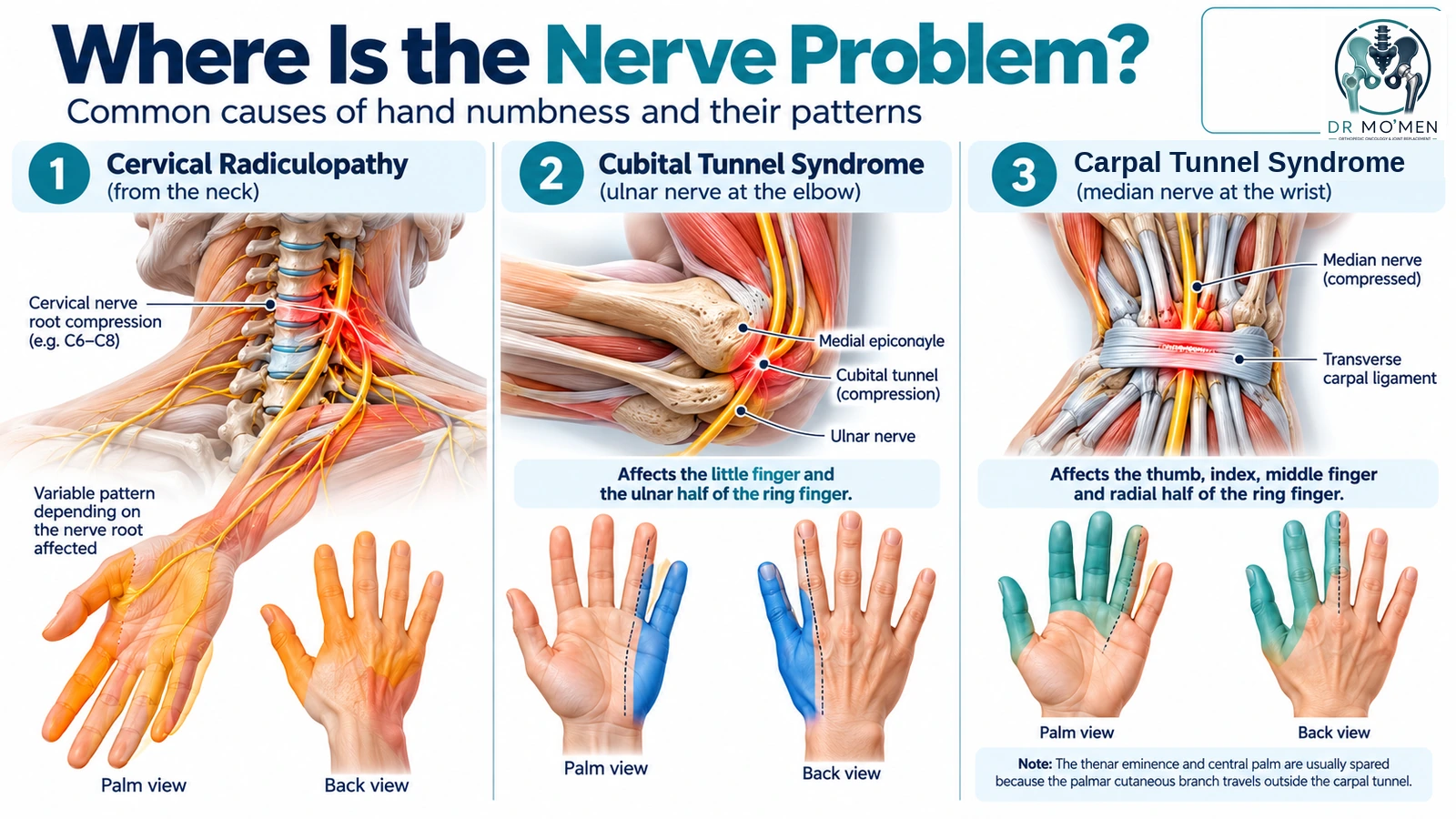 Infographic comparing cervical radiculopathy, cubital tunnel syndrome and carpal tunnel syndrome with their typical sensory patterns.