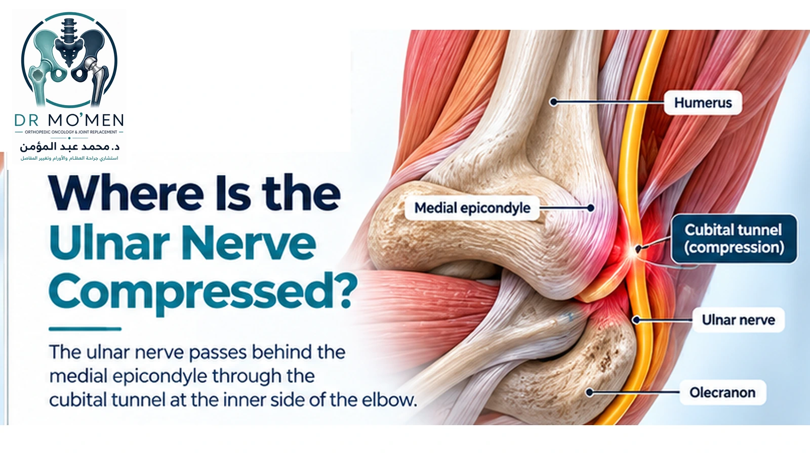 3D medical illustration showing the ulnar nerve passing behind the medial epicondyle through the cubital tunnel.