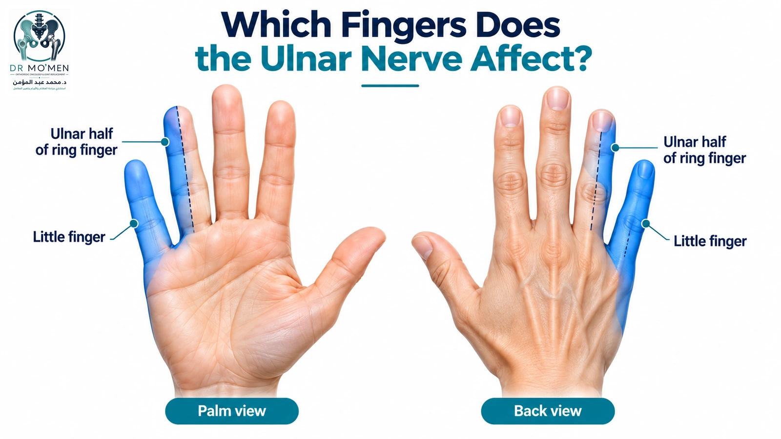 Palmar and dorsal hand infographic showing the little finger and ulnar half of the ring finger as the ulnar sensory territory.