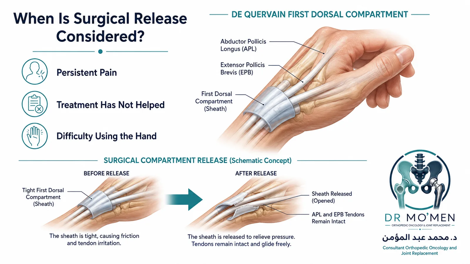 Medical infographic explaining when surgical release may be considered and showing the tendons remaining intact after sheath release.
