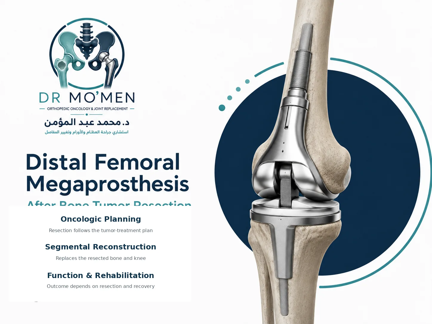 Distal femoral megaprosthesis reconstructing the knee after bone tumor resection