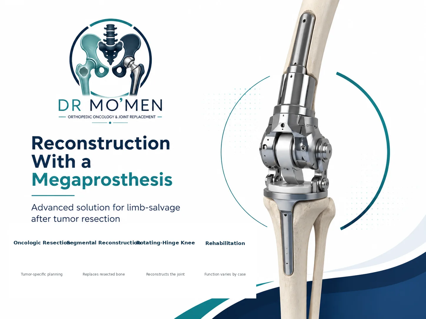 Modular distal femoral megaprosthesis replacing resected bone and reconstructing the knee