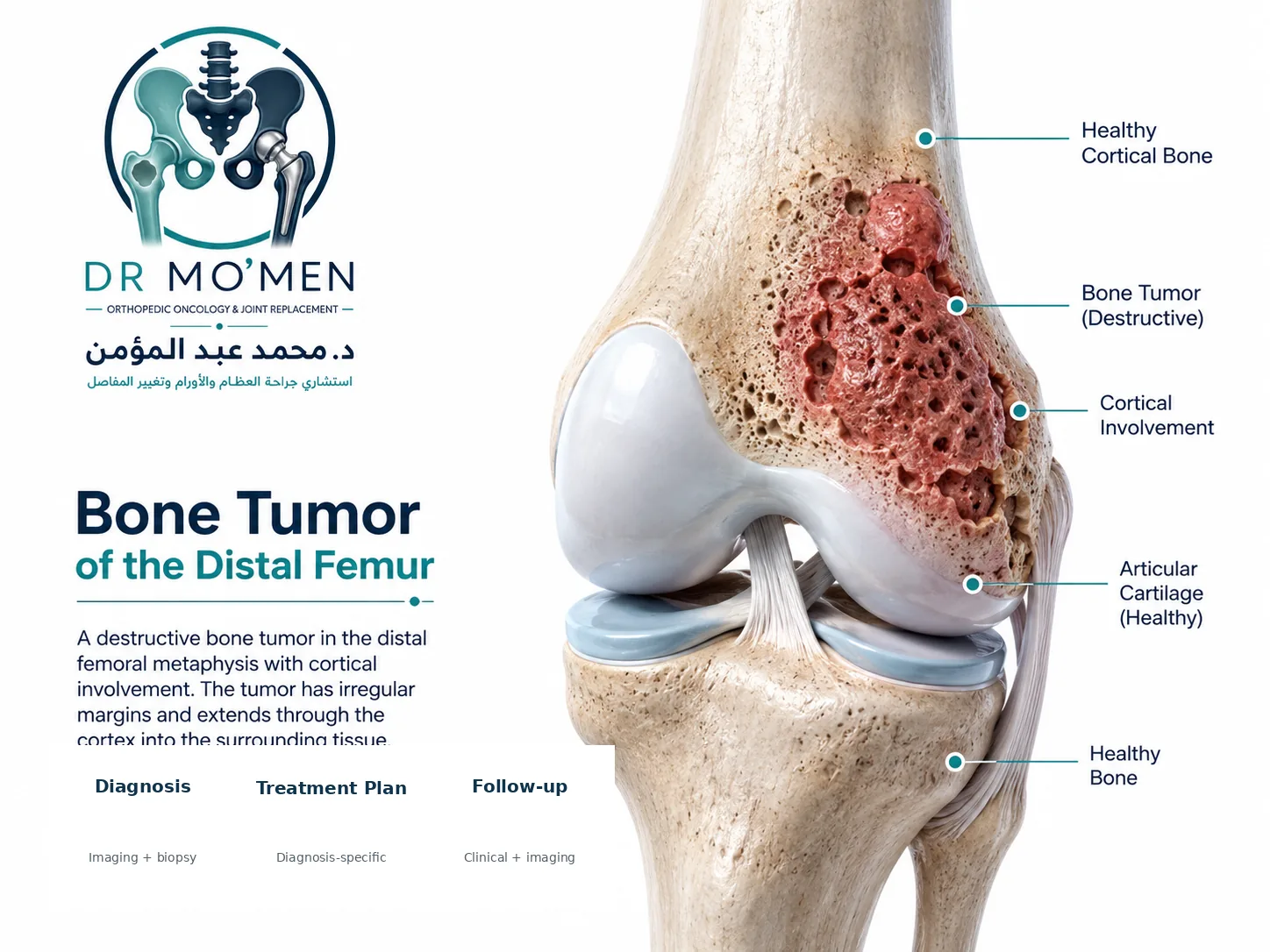 Bone tumor involving the distal femur near the knee joint