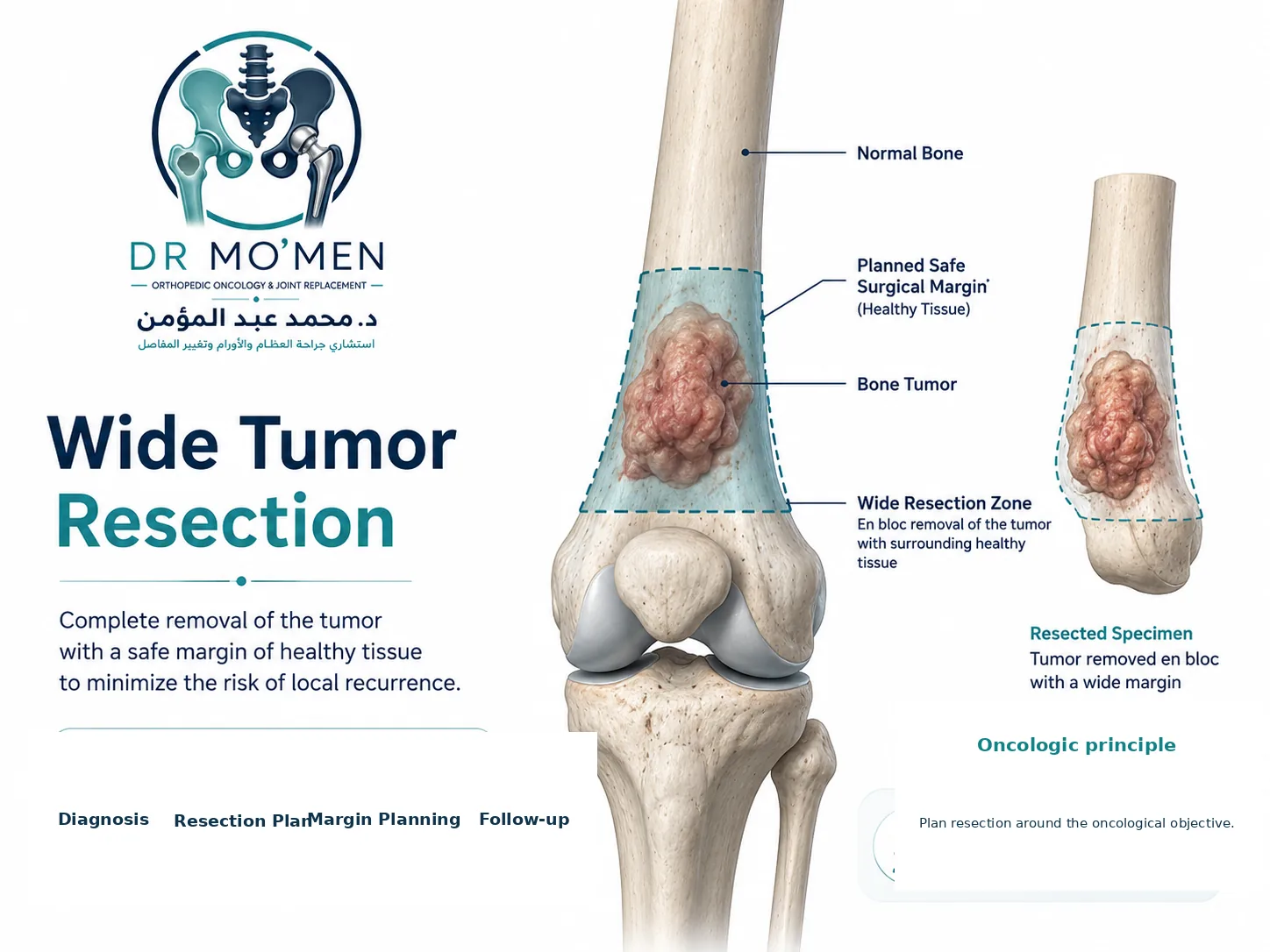 Illustration showing wide resection of a distal femoral bone tumor