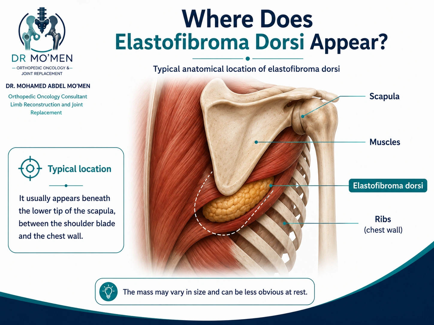 Anatomical illustration showing the typical infrascapular location of elastofibroma dorsi between the scapula and chest wall