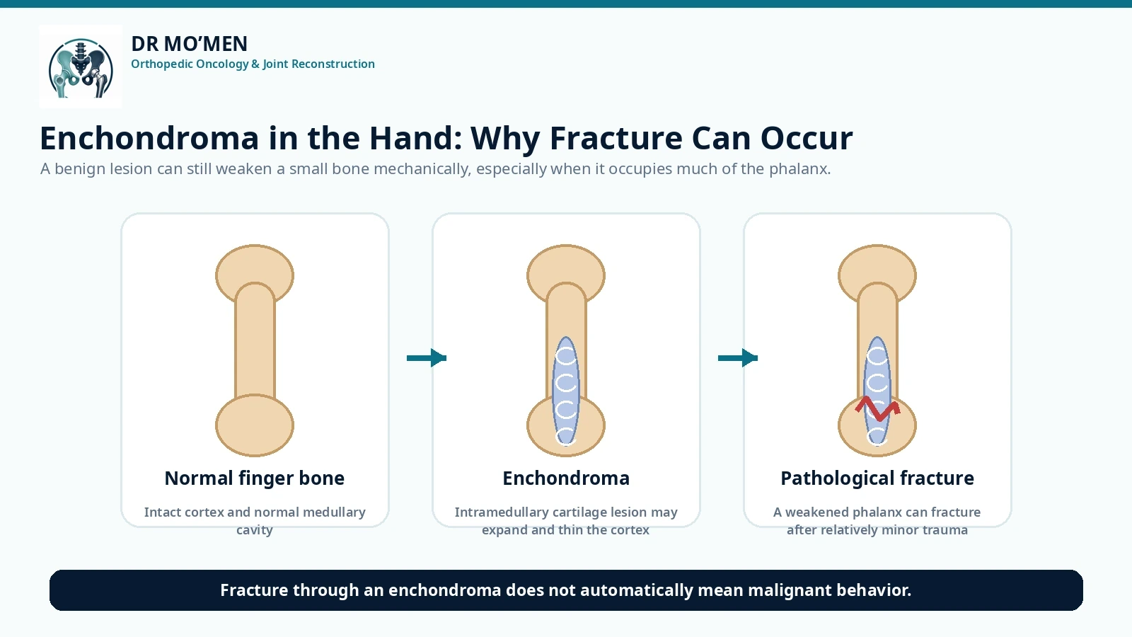 Scientifically accurate illustration showing an enchondroma occupying a finger phalanx and weakening the bone, with potential pathological fracture.