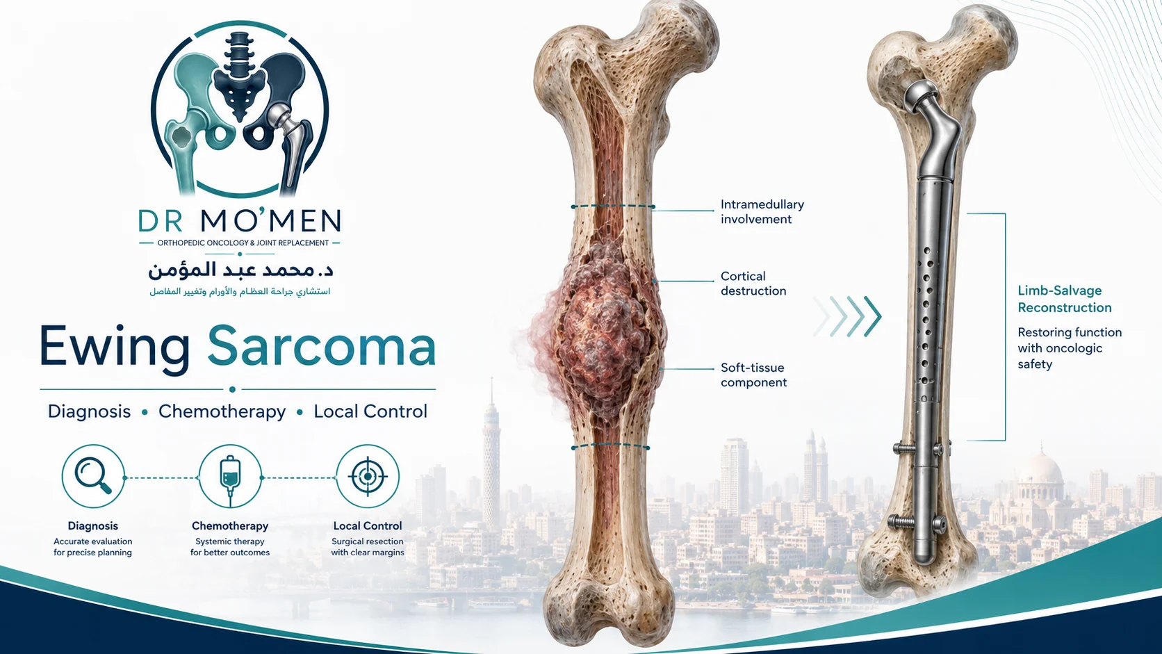 3D orthopedic oncology illustration showing Ewing sarcoma of a long bone with chemotherapy and limb-salvage treatment concepts