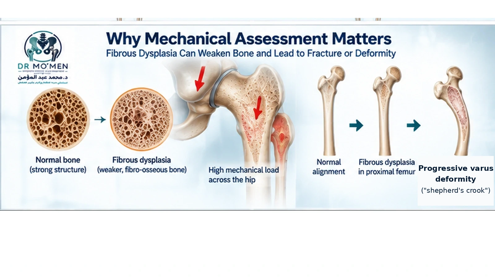 Medical illustration showing how extensive proximal femoral fibrous dysplasia can weaken bone and contribute to fracture and progressive varus deformity.