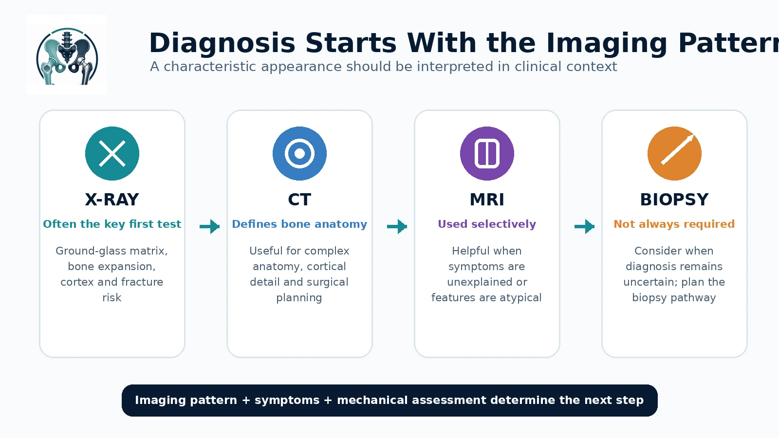 Orthopedic oncology infographic showing the characteristic X-ray appearance of fibrous dysplasia and when CT, MRI or biopsy may be considered.