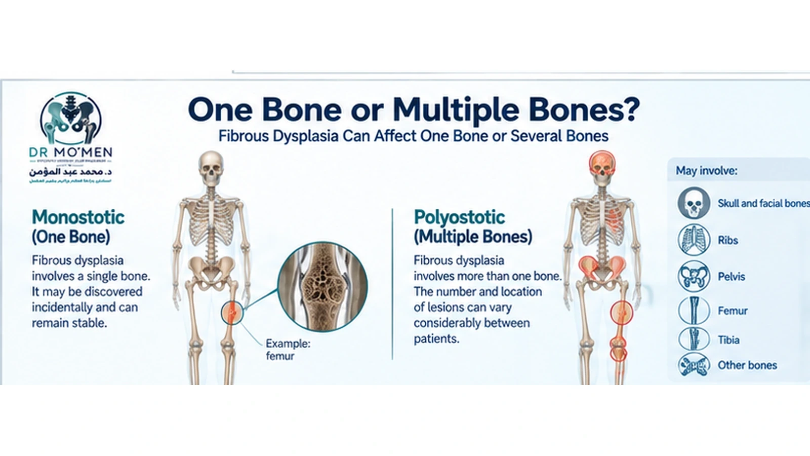 Medical illustration explaining monostotic and polyostotic patterns of fibrous dysplasia.