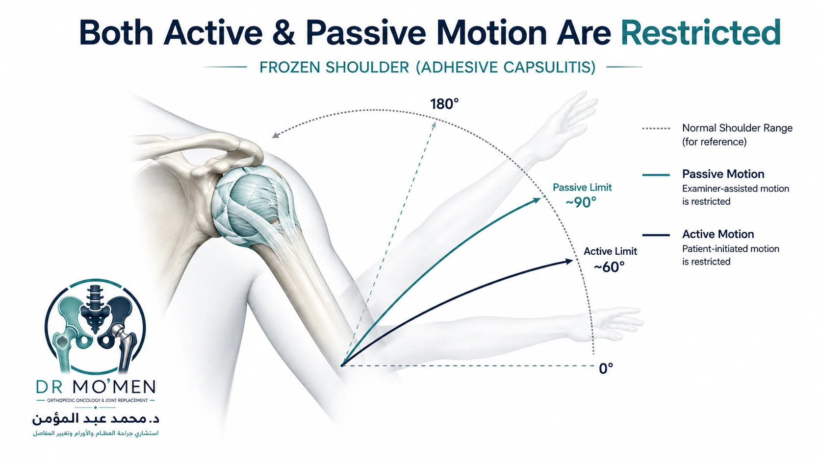 Medical infographic showing restriction of both active and passive shoulder motion in frozen shoulder.