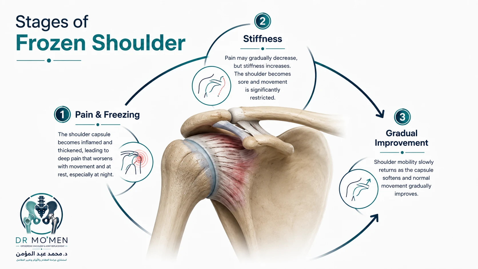 Educational illustration of the stages of frozen shoulder from pain and freezing to stiffness and gradual improvement.