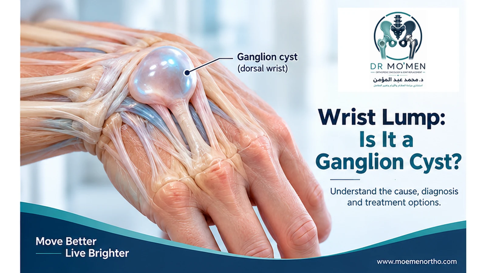 3D medical illustration of a dorsal wrist ganglion cyst arising near the wrist joint.