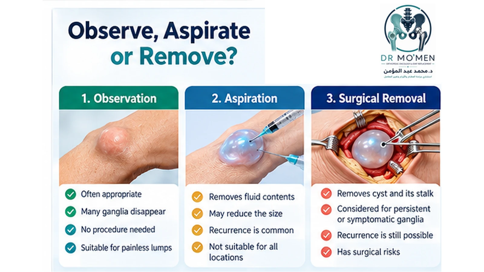 Infographic showing observation, aspiration and surgical removal for selected wrist ganglion cysts.