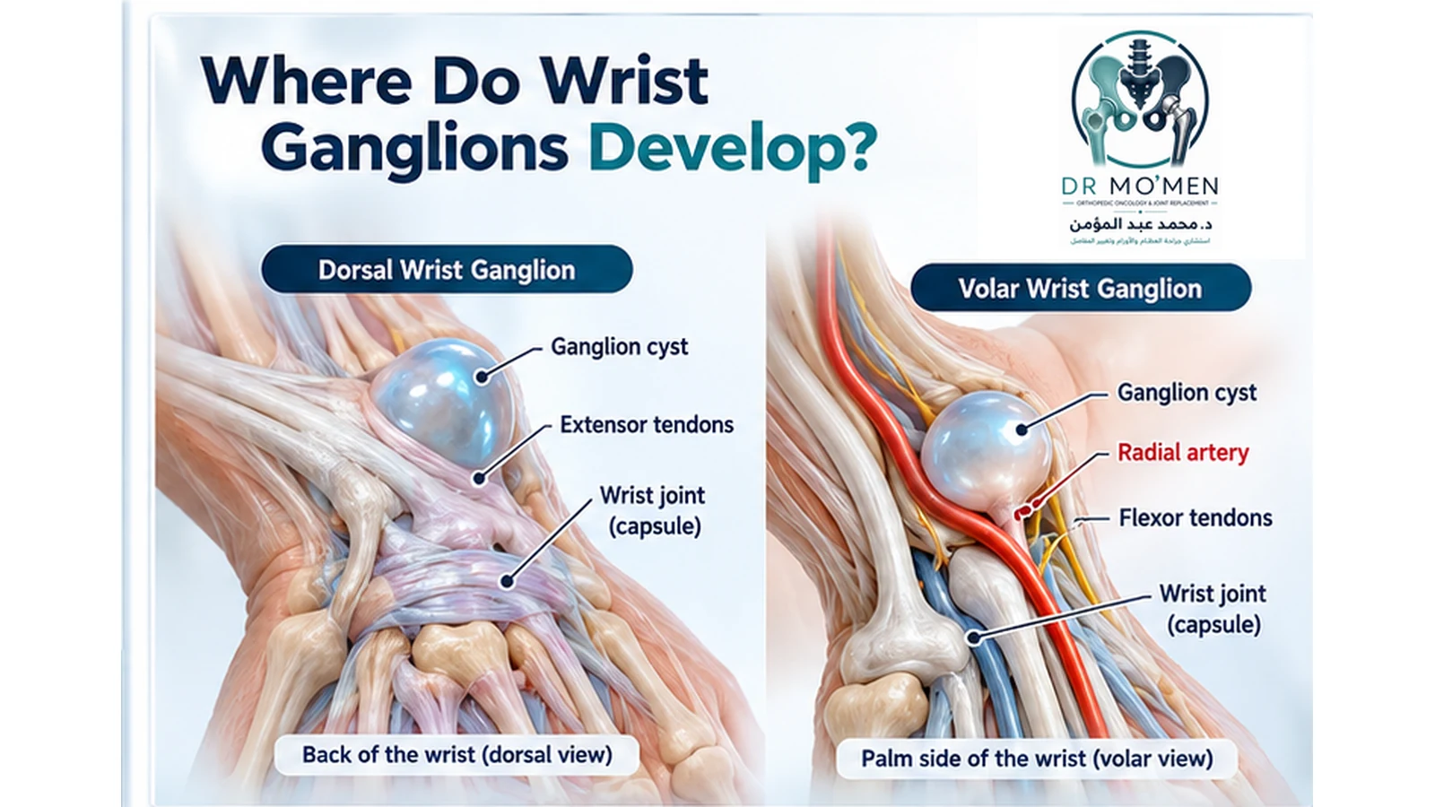 Medical illustration comparing dorsal and volar wrist ganglion cysts, including the radial artery relationship.