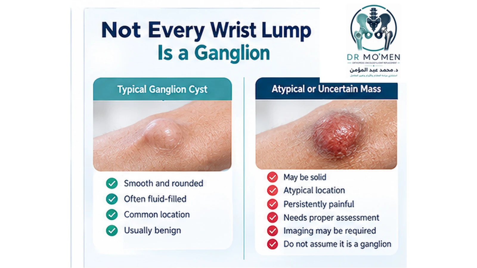 Infographic comparing a typical ganglion cyst with an atypical or uncertain wrist mass requiring assessment.