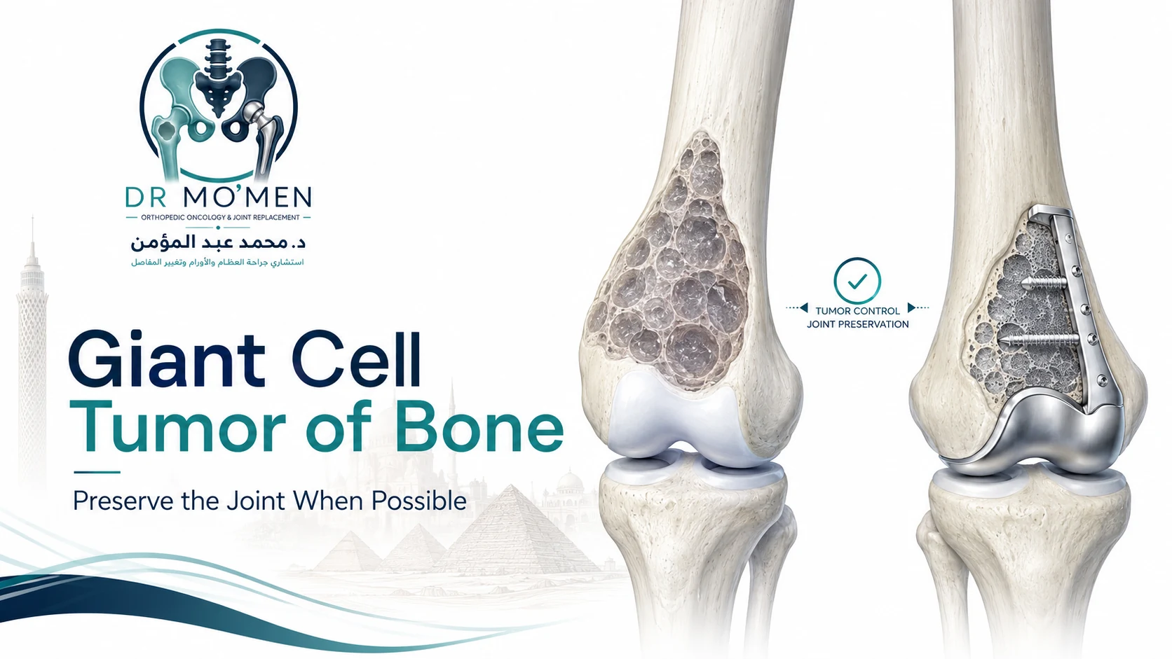 3D medical illustration showing giant cell tumor of the distal femur with a joint-preserving treatment concept