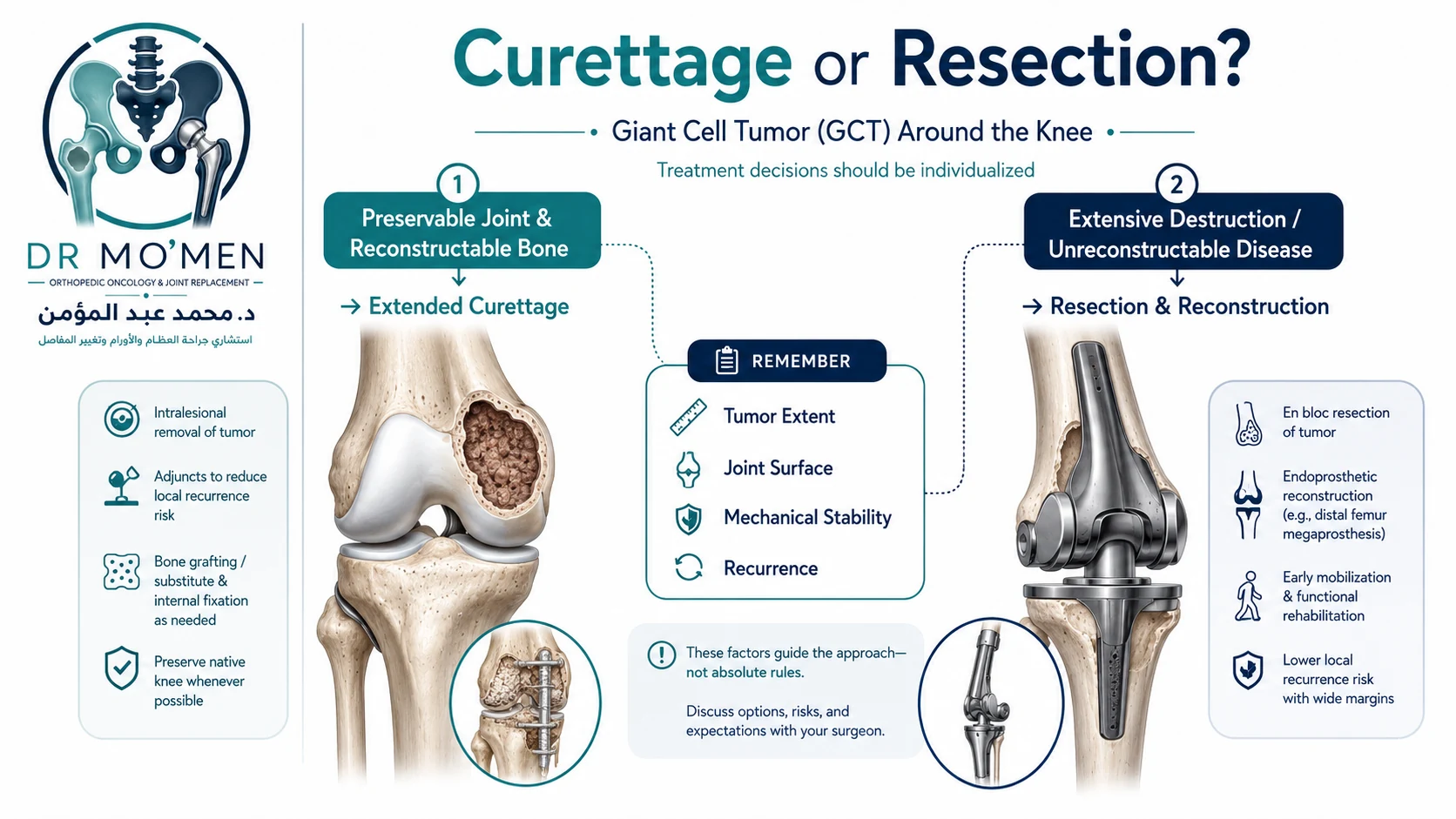 Orthopedic oncology infographic explaining when giant cell tumor may be treated with extended curettage or wider resection and reconstruction