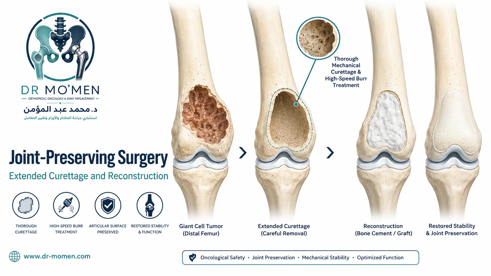 Medical illustration explaining extended curettage and reconstruction of giant cell tumor while preserving the knee joint