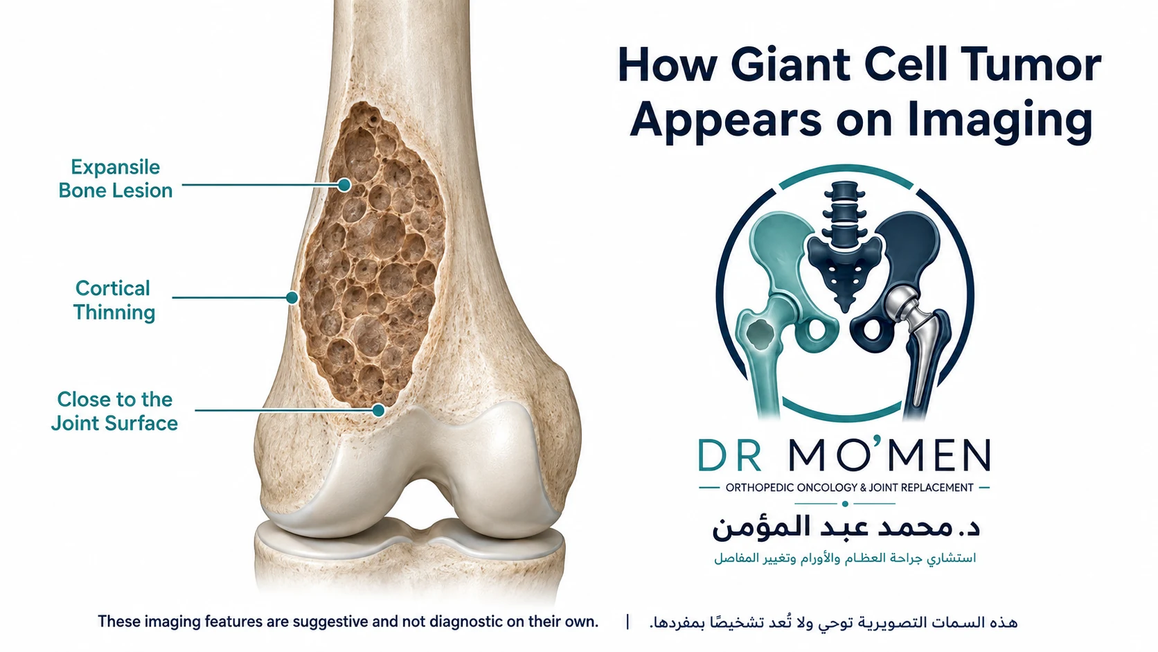 3D medical illustration showing an eccentric expansile giant cell tumor near the knee joint