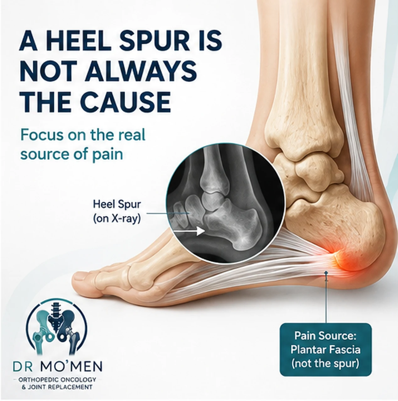 Medical illustration showing that a heel spur can be incidental rather than the pain generator
