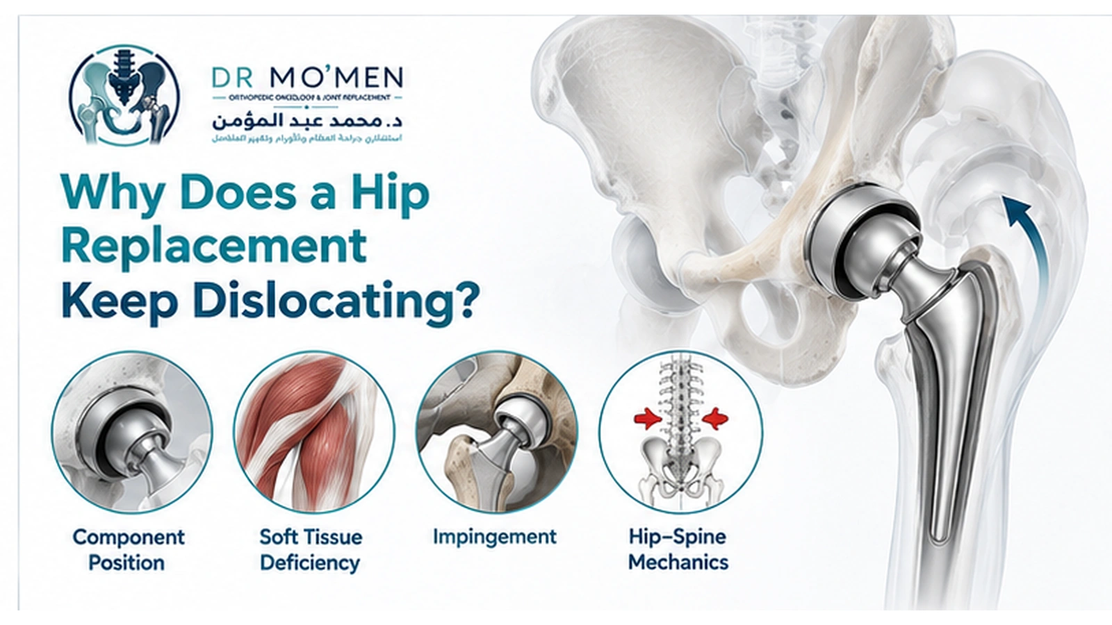 Why Does a Hip Replacement Keep Dislocating? Medical illustration explaining component position, soft-tissue deficiency, impingement and hip-spine mechanics as causes of recurrent hip replacement instability.