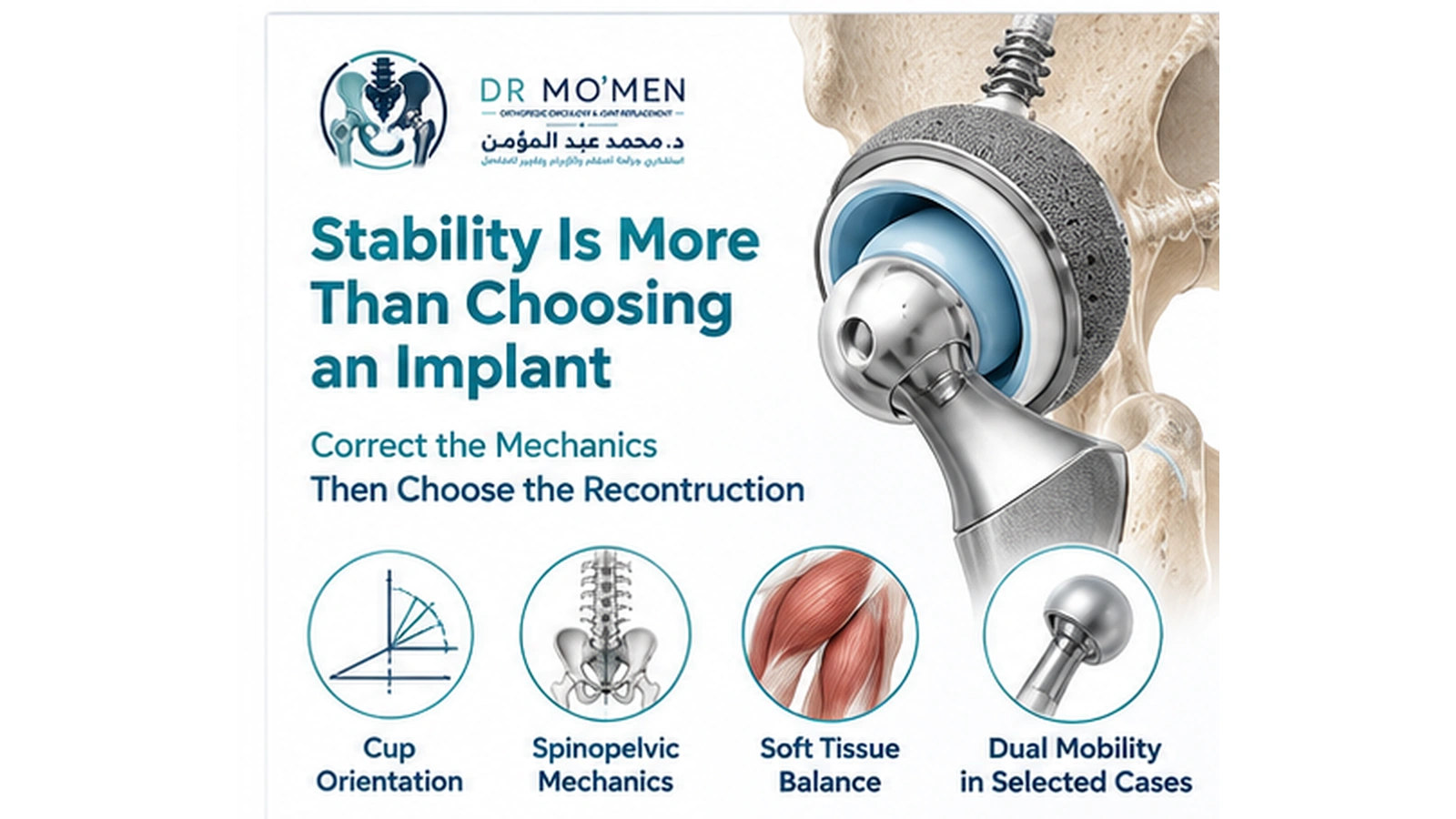 Stability Is More Than Choosing an Implant Medical illustration showing dual-mobility revision hip reconstruction and biomechanical planning for recurrent instability.