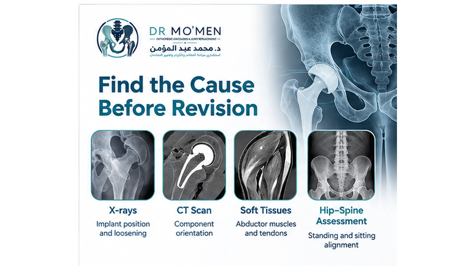 Find the Cause Before Revision Infographic showing X-rays, CT, soft-tissue evaluation and hip-spine assessment before revision surgery for recurrent hip replacement dislocation.