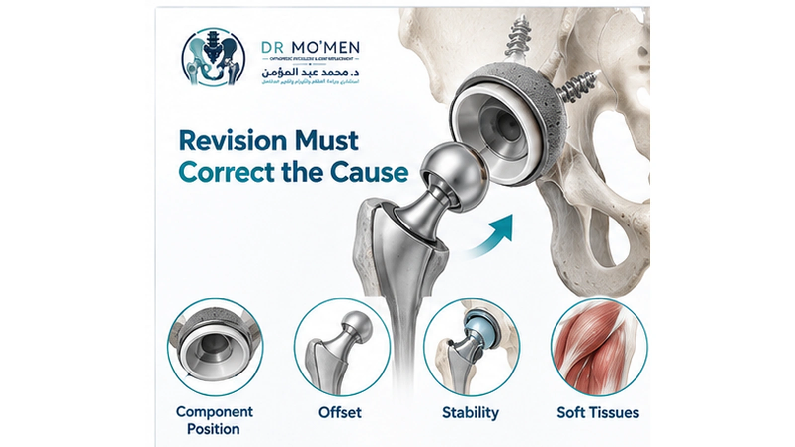 Revision Must Correct the Cause 3D medical visualization showing revision reconstruction to correct component position, offset, stability and soft-tissue tension in recurrent hip instability.