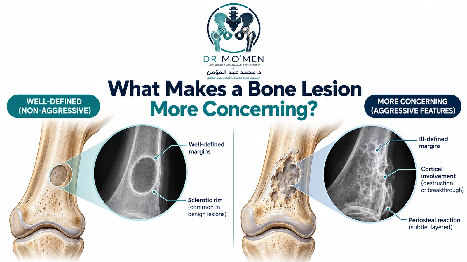 What Makes a Bone Lesion More Concerning? Medical infographic comparing a well-defined non-aggressive bone lesion with an indeterminate lesion showing concerning radiographic features.