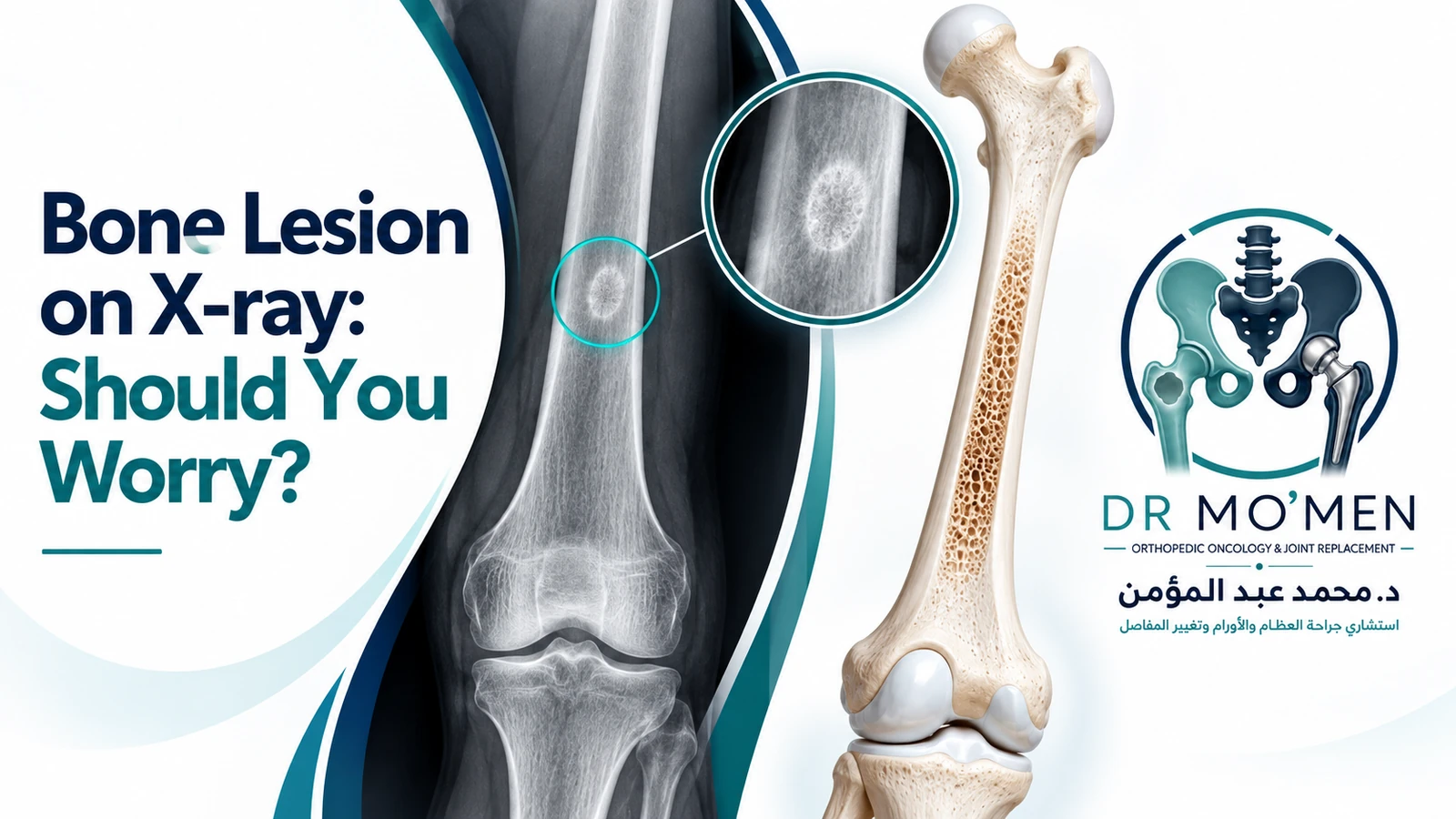 Bone Lesion on X-ray: Should You Worry? Branded orthopedic oncology illustration showing an incidental focal bone lesion on X-ray with a corresponding long-bone anatomy view.