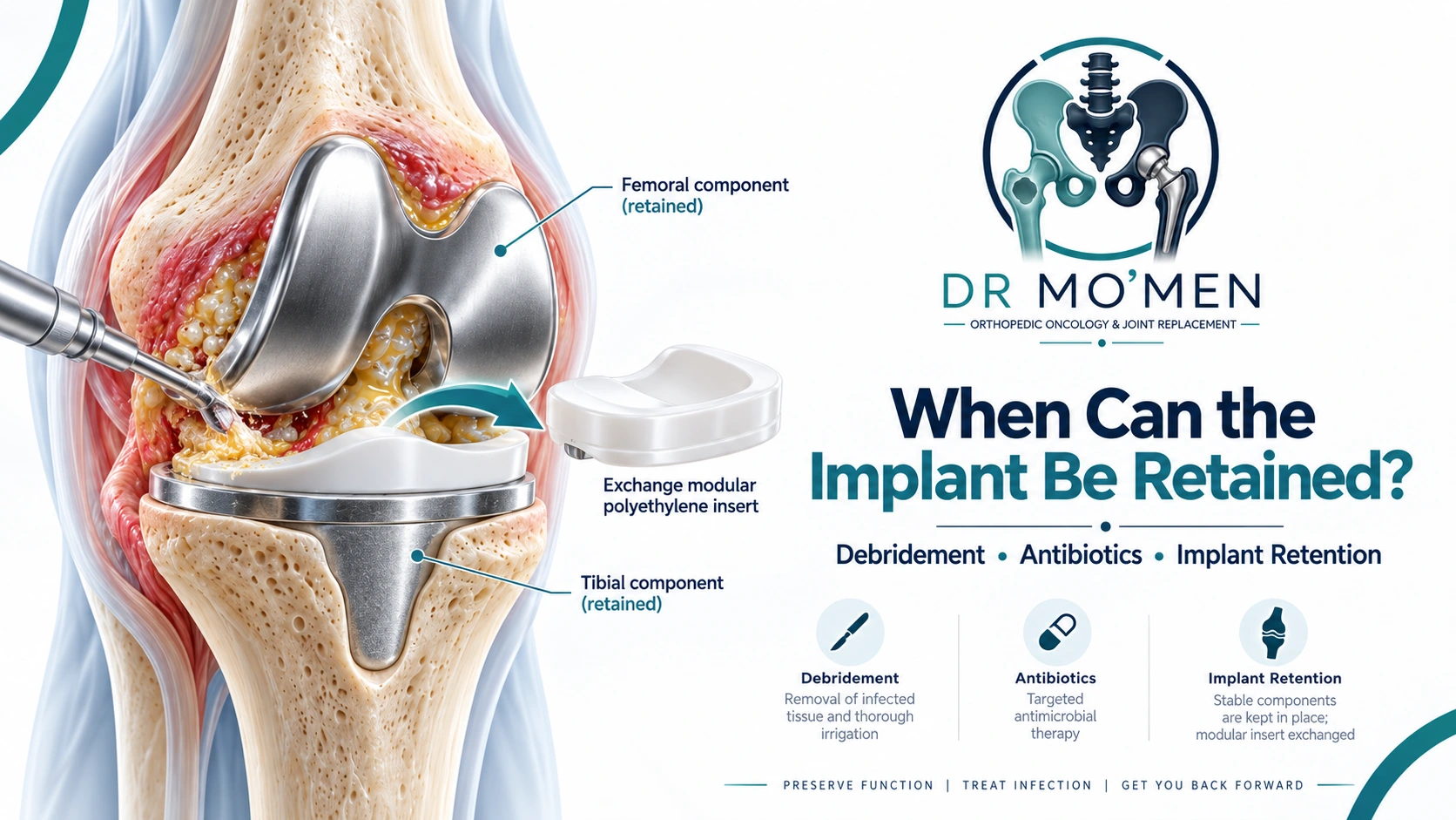 When can the implant be retained?