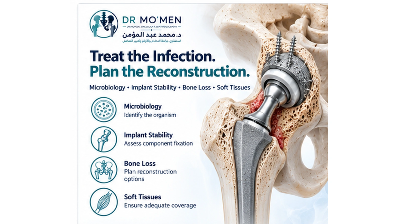 Treat the Infection. Plan the Reconstruction. 3D medical visualization showing infection control, bone loss assessment and revision implant planning for complex infected hip replacement surgery.