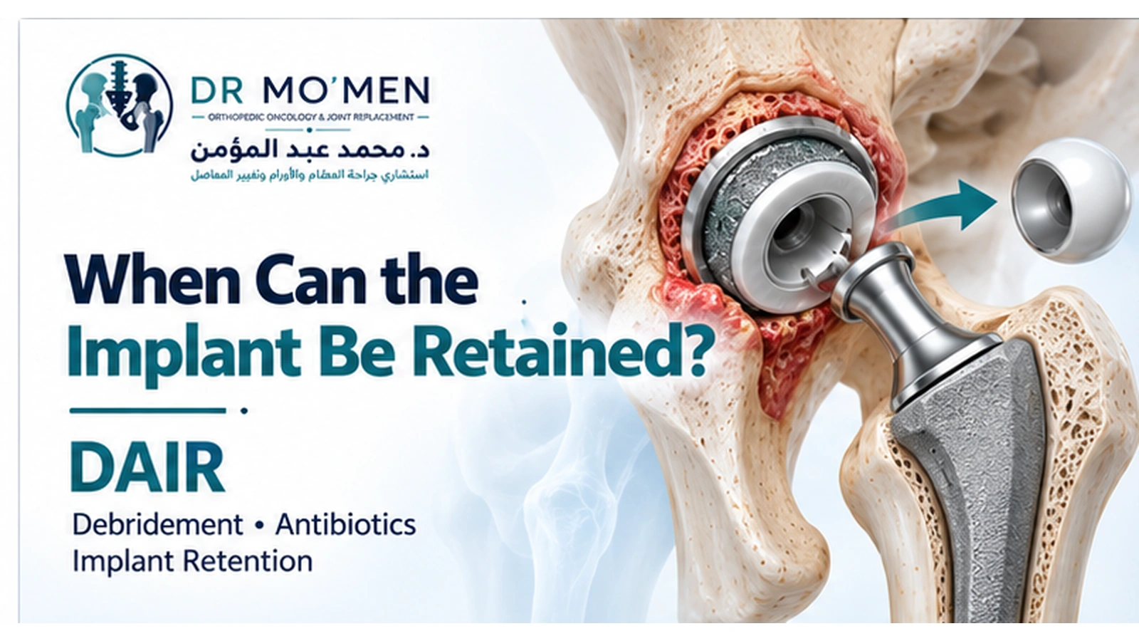 When Can the Implant Be Retained? Medical illustration showing DAIR treatment with retention of stable hip replacement components and exchange of modular components.